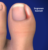 Ingrown